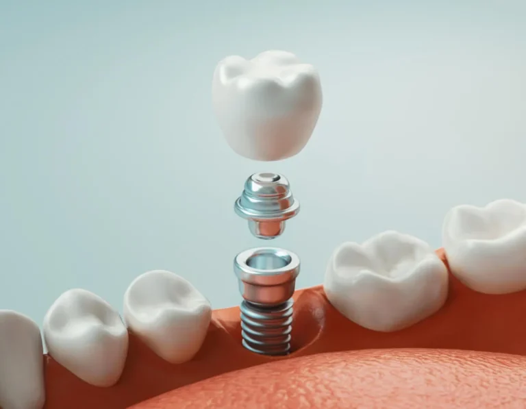 implant zęba