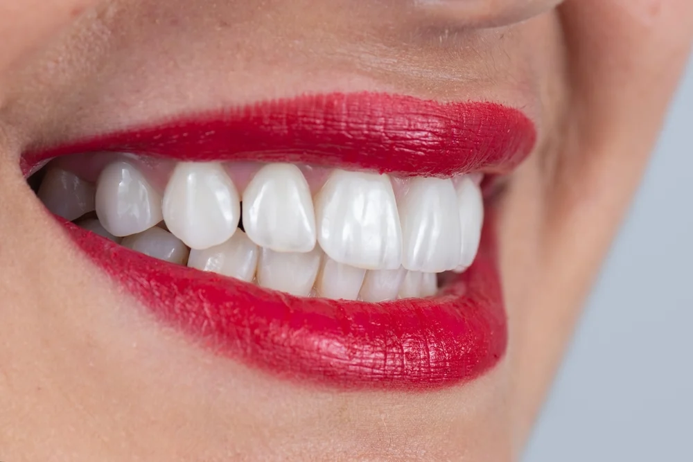 Licówki porcelanowe