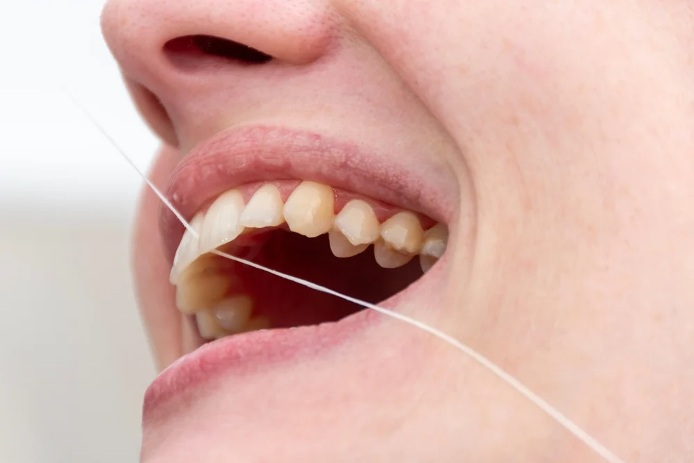 Krwawienie przy nitkowaniu zębów